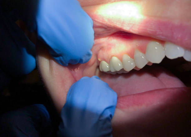 Best Emergency Cosmetic Dentistry (e.g., broken veneers) in Fort Lewis, WA